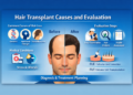 Hair Transplant Causes and Evaluation: Understanding Hair Loss and Treatment